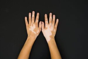 Tratamento para Vitiligo